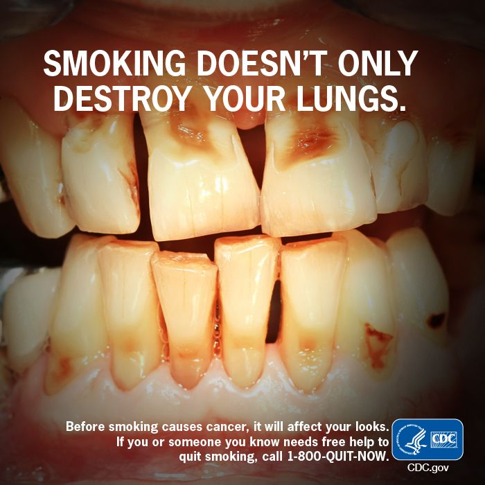 Smoking is a major cause of mouth diseases such as periodontitis (gum